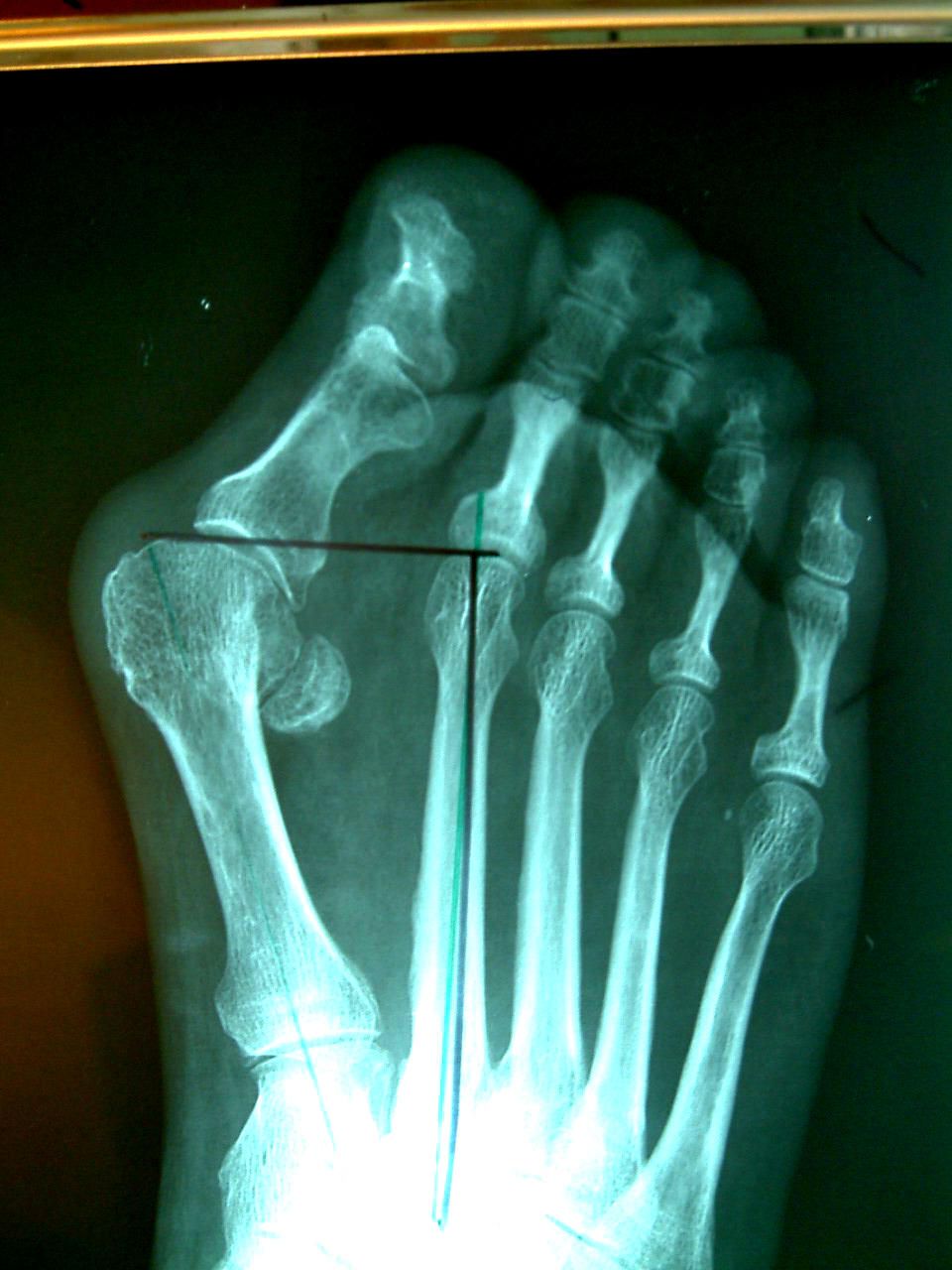 Отклонение пальца кнаружи (рентген)